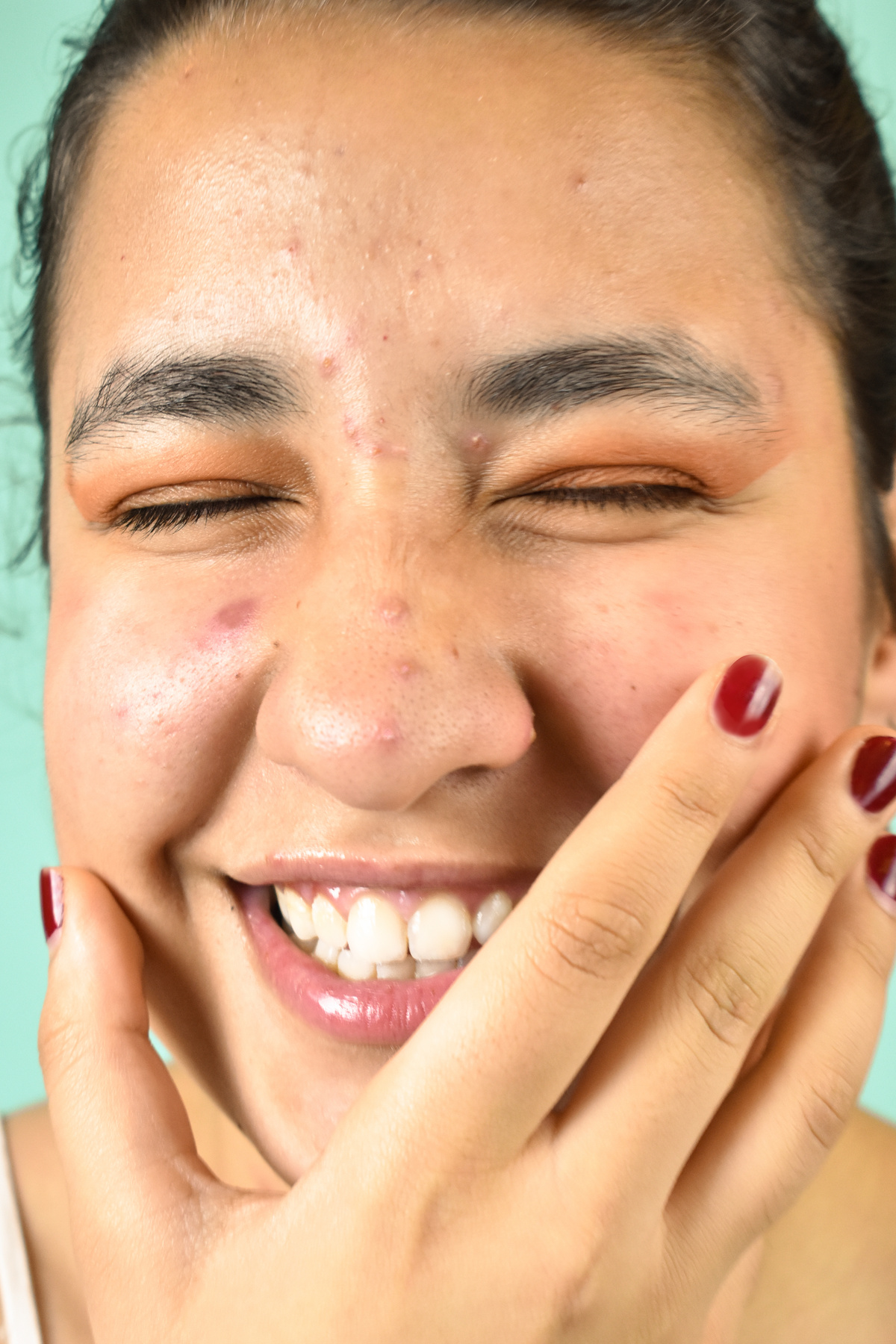 Happy Woman with Pimples Touching Her Face